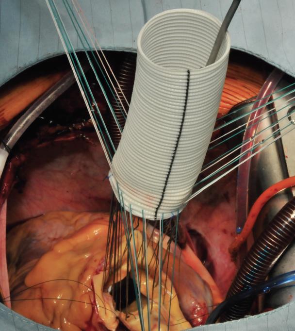 how is aortic aneurysm surgery performed